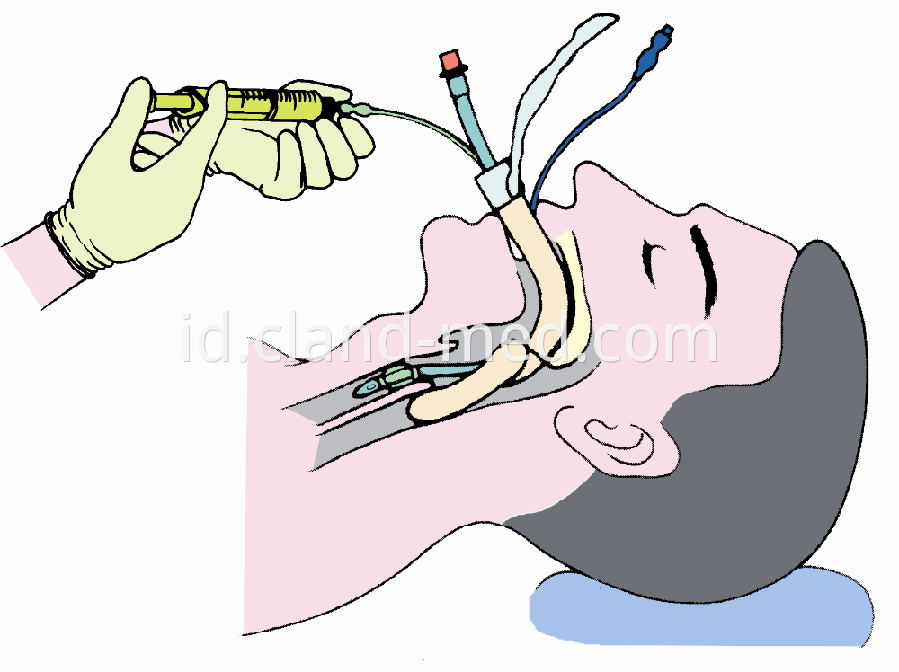 Tracheostomy Set